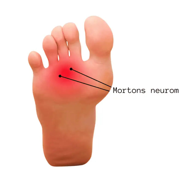 Mortonin neurooma
