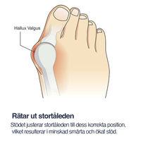 Korjaava hallux valgus -tuki varvasseurain kanssa (2-pakkaus)